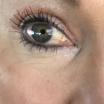 Muir Eye Care - One month after Oasis temporary plugs and my eyes aren't bright red by the end of the day. - Ophthalmologists Near Me - Concord, California Muir Eye Care - One month after Oasis temporary plugs and my eyes aren't bright red by the end of the day. - Ophthalmologists Near Me - Concord, California
