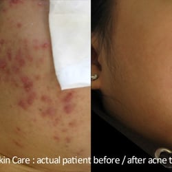 Skin Solution SF Acne Clinic