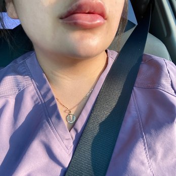Devine Image - 2 days post op - Medical Spas Near Me - Tustin, California Devine Image - 2 days post op - Medical Spas Near Me - Tustin, California