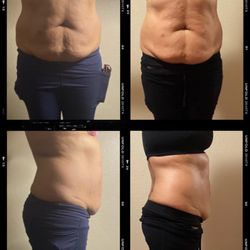 Belleza Vibes - Results From 3 Wood Therapy Sessions.
