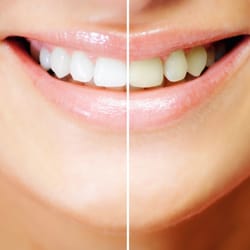 Regents Dental Group - Regents Dental can whiten your teeth in one visit!
