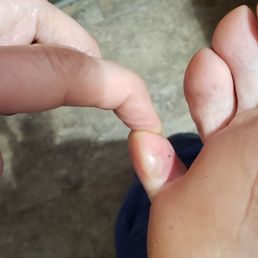 The fungus from my pedicure....