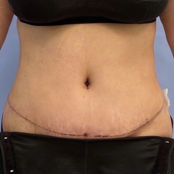 Catherine Begovic, MD - One week after no bruising!!! - Cosmetic Surgeons Near Me - Beverly Hills, California