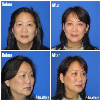 Shahram Salemy, MD - Before and After Eyelid and Browlift Surgery - Cosmetic Surgeons Near Me - Seattle, Washington