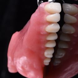 UCLA Maxillofacial Prosthetics Clinic - Obturator: a prosthesis that helps restore a patient's speech and swallowing