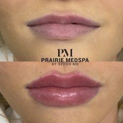 Prairie Medical Spa - Lip enhancement at Prairie Medical Spa