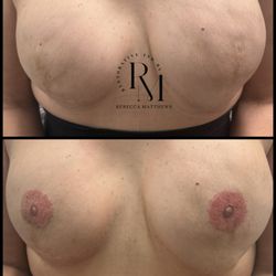  Restorative Ink by Rebecca Matthews  - Medical purposes post mastectomy