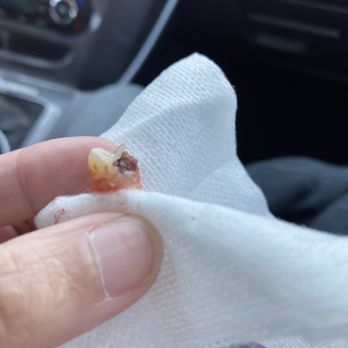 Delicate Oral Surgery - Chipped and out! - Oral Surgeons Near Me - Las Vegas, Nevada