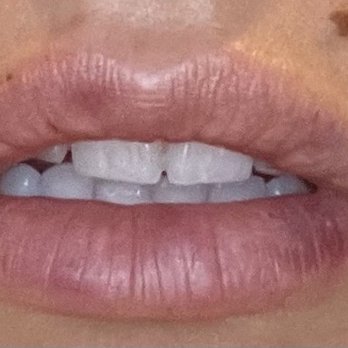 iGlow Med Spa - a few hours after, a little bruising - Medical Spas Near Me - Beverly Hills, California