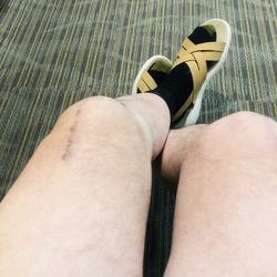 Grossmont Orthopaedic Medical Center - Total left knee replacement