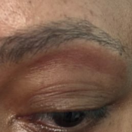 Waxing burn. THEY WILL NOT REFUND YOU, EVEN WHEN THEY BURN YOU. Waxing burn. THEY WILL NOT REFUND YOU, EVEN WHEN THEY BURN YOU.