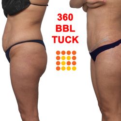 Pelosi Medical Center - Tummy Tuck. With lipo 360 and BBL for a tighter, youthful appearance.