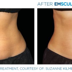 Bio-tique - Body Sculpting with Emsculpt Neo