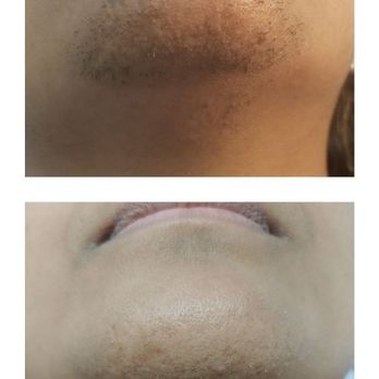 RG Pro Laser - Laser Hair Removal Near Me - Arlington, Massachusetts