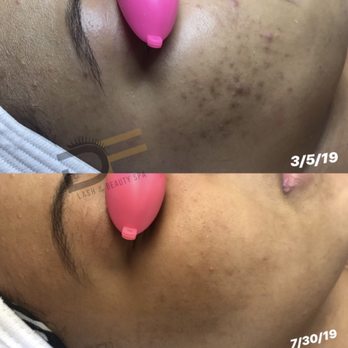 Dream Facials - Acne treatment - Skin Care Near Me - Reynoldsburg, Ohio