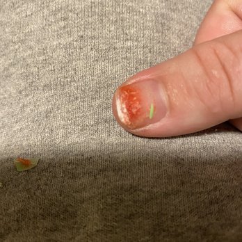 Dalin's Nail & Spa - My nail was infected severely by the second day - Nail Salons Near Me - Lyman, South Carolina Dalin's Nail & Spa - My nail was infected severely by the second day - Nail Salons Near Me - Lyman, South Carolina