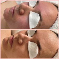 Clean Skin - Before and after Perfect Skin peel followed by Skin Repair