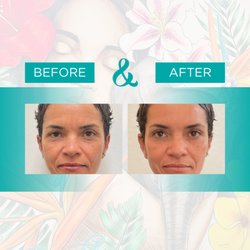 Natasha Bernard, DO - Alchemy Restorative Medicine - Sculptra before and after