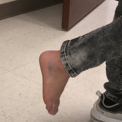 Arrowhead Orthopaedics Physical & Occupational Therapy - Hemet - 3rd degree ankle sprain/ physical therapy