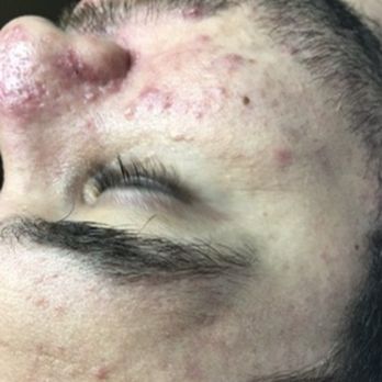 Acne Treatment SF - Skin Care Near Me - San Francisco, California Acne Treatment SF - Skin Care Near Me - San Francisco, California