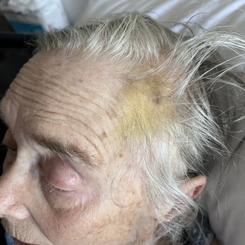 Aaspen Village Care - Bruises on mothers head - Memory Care Near Me - Yucca Valley, California Aaspen Village Care - Bruises on mothers head - Memory Care Near Me - Yucca Valley, California