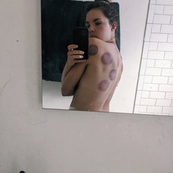 Find Your Chi Acupuncture - Cupping session! And no, it doesn't hurt :) cupping can feel intense - like a deep tissue massage - but the resulting spots aren't painful