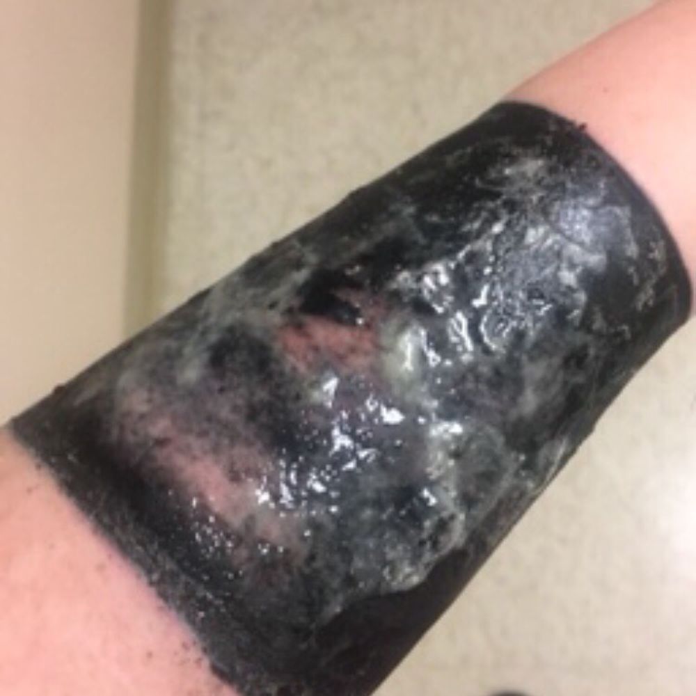 Pus mixed with the antibacterial ointment the doctor prescribed. This was after the first time I went to the ER. (Between changing bandages) Pus mixed with the antibacterial ointment the doctor prescribed. This was after the first time I went to the ER. (Between changing bandages)