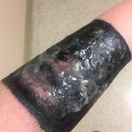 Pus mixed with the antibacterial ointment the doctor prescribed. This was after the first time I went to the ER. (Between changing bandages) Pus mixed with the antibacterial ointment the doctor prescribed. This was after the first time I went to the ER. (Between changing bandages)