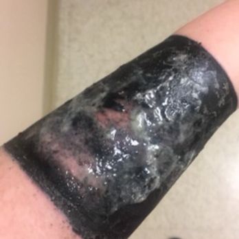 Fluid Ink - Pus mixed with the antibacterial ointment the doctor prescribed. This was after the first time I went to the ER. (Between changing bandages) - Tattoo Near Me - Arlington, Virginia Fluid Ink - Pus mixed with the antibacterial ointment the doctor prescribed. This was after the first time I went to the ER. (Between changing bandages) - Tattoo Near Me - Arlington, Virginia