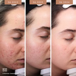 Bay Area Cosmetic Dermatology - Stunning progression photos of acne treatment with Cynthia Chaghouri, PA-C.