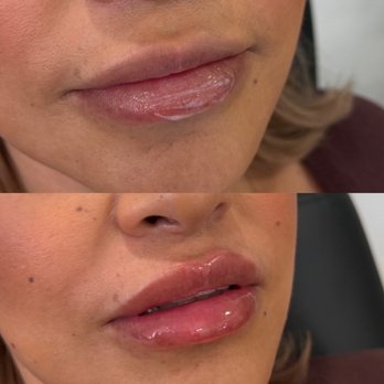 Nakedmd - My lip filler! So happy with my natural results - Medical Spas Near Me - Newport Beach, California