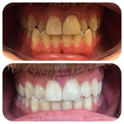 ISmile Dental - Before and After  Invisalign and Zoom 1 hour whitening Completed by Dr Alla Alpert