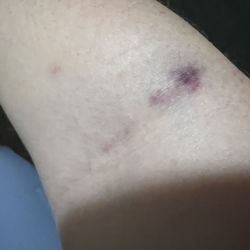 Quest Diagnostics - Bruising post one day after blood work