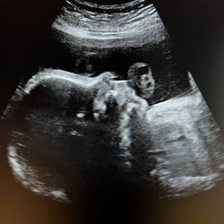 Baby Waves Imaging - 2D profile at @28 weeks