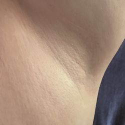 Milan Institute - Sparks - Underarm 1 week after last waxing