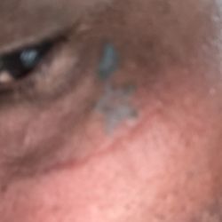 X-Tattoo - Tattoo that X tattoo is removing