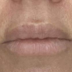 NeoMed - 13 days post filler. Puffiness above lip line, upper lip is large & awkward looking.
