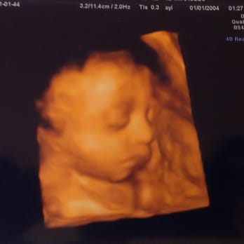 4D Miracles - Babygirl 29 weeks - Ultrasound Imaging Centers Near Me - Fremont, California 4D Miracles - Babygirl 29 weeks - Ultrasound Imaging Centers Near Me - Fremont, California