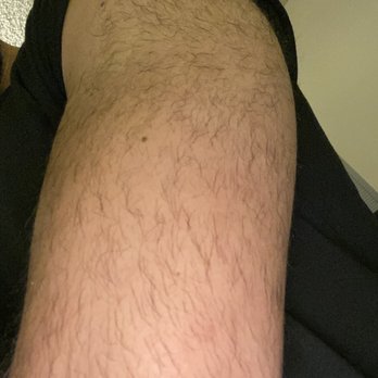 LaserAway - This is what 23 laser sessions on a "perfect" candidate looks like the results are non existent! - Laser Hair Removal Near Me - Walnut Creek, California LaserAway - This is what 23 laser sessions on a "perfect" candidate looks like the results are non existent! - Laser Hair Removal Near Me - Walnut Creek, California