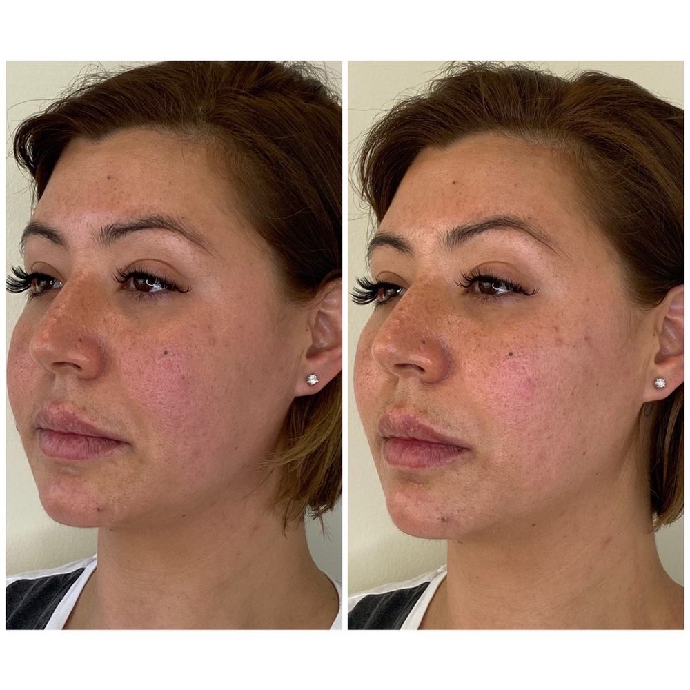 SkinSplendid - Before and after my amazing silhouette thread lift! - Medical Spas Near Me - Montclair, New Jersey