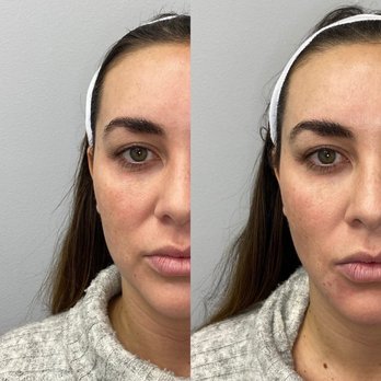 Kora Aesthetics - Temple filler and cheek filler to enhance the face shape. Facial balancing and natural results are our specialty. - Medical Spas Near Me - Scottsdale, Arizona Kora Aesthetics - Temple filler and cheek filler to enhance the face shape. Facial balancing and natural results are our specialty. - Medical Spas Near Me - Scottsdale, Arizona