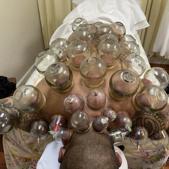 1. Jun Yi acupuncture