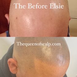 SMP Hair Clinic The Queen Of Scalp - Male pattern baldness SMP by Elsie