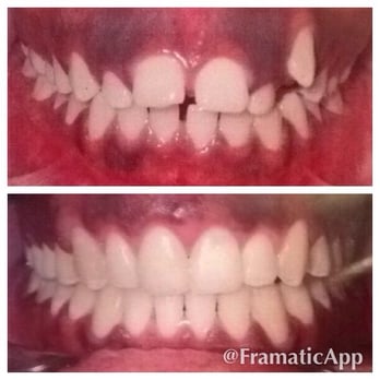 Northshore Orthodontics - Before and After: 2 YEARS - Orthodontists Near Me - Whitestone, New York Northshore Orthodontics - Before and After: 2 YEARS - Orthodontists Near Me - Whitestone, New York
