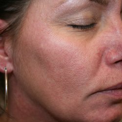 Bellevue Medispa - After laser treatment!  Thanks Liz!