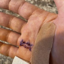 Hand surgery.