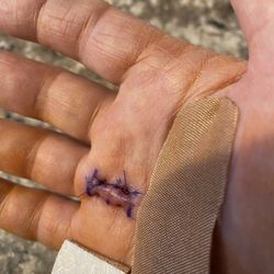 Rothman Orthopaedics - Hand surgery.