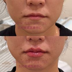 Skinspire Laser & Skin Clinic - Juvederm filler
