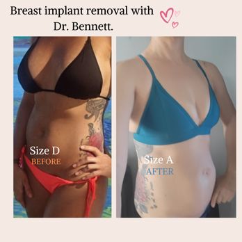 Gemini Plastic Surgery - 10 days after breast implant removal with amazing Dr. Bennett. - Laser Hair Removal Near Me - Rancho Cucamonga, California Gemini Plastic Surgery - 10 days after breast implant removal with amazing Dr. Bennett. - Laser Hair Removal Near Me - Rancho Cucamonga, California