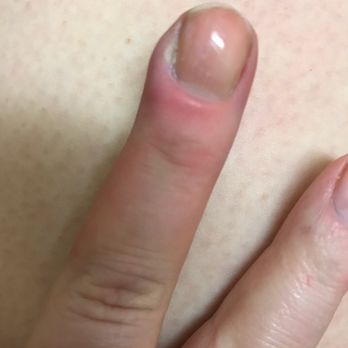 Crimson Nails & Spa - Went here to get gel polish taken off and two days later I have this!  Wouldn't go here again!  Disgusting!! - Nail Salons Near Me - Bloomington, Indiana